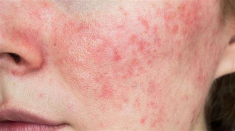 Minocycline For Acne And Rosacea Advanced Dermatology Of The Midlands