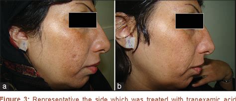 Figure 1 From Topical Tranexamic Acid As A Promising Treatment For