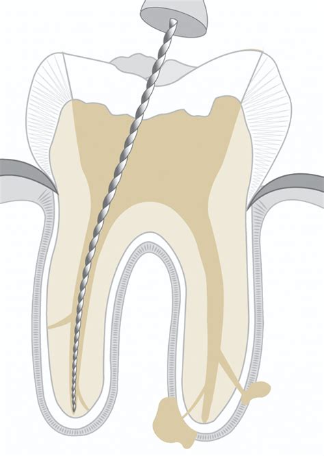 Zahnarzt Bruchsal Synerdent Wurzelbehandlung Endodontische Therapie