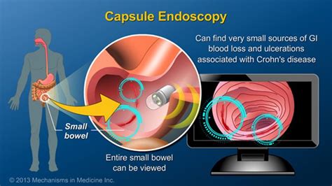 Capsule Endoscopy Allows Viewing Of The Entire Small Bowel It Is The