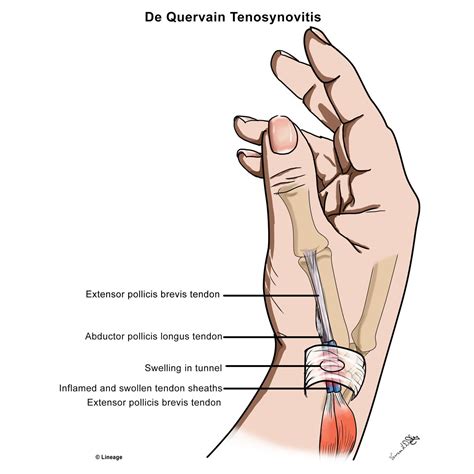 De Quervain Tenosynovitis Orthopedics Medbullets Step
