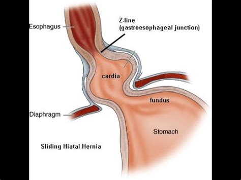 Diaphragmatic Hiatal Hernias Week Winter Lecture Youtube