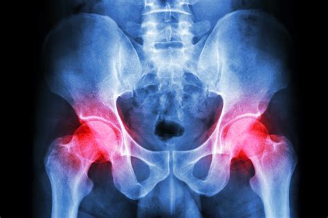 Hip Replacement Device Failure Faqs Rasmussen And Miner Utah