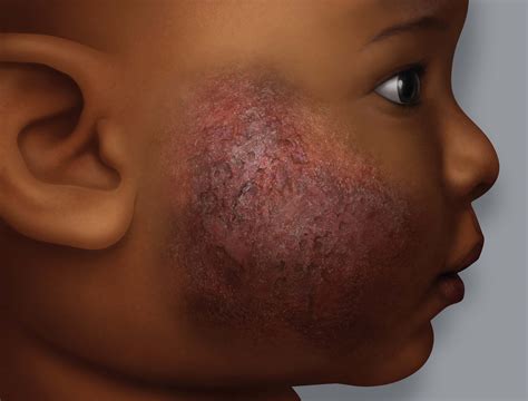 Eczema On Dark Skin Eczema Foundation