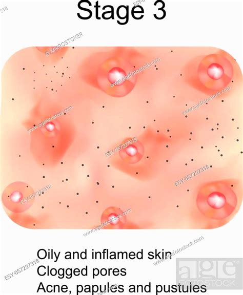 Stage 3 Of Development Of Acne Inflamed Skin With Scars Acne And