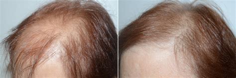 Hair Transplants For Women Photos Miami Fl Patient59153