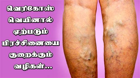 Varicose Veins Cause And How To Prevent Varicose Veins Youtube