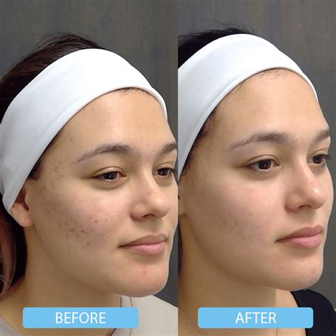 Acne And Acne Scars Treatment In Toronto Vita Cosmetic And Laser Clinic