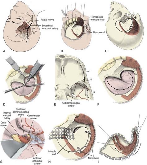 Surgical Approaches To Intracranial Aneurysms Neupsy Key