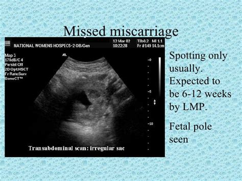 Miscarriage Signs At 5 Weeks Miscarriage Causes Signs And Symptoms