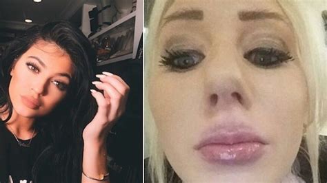 Woman Uses Hairspray Bottle To Get Kylie Jenner Lips Fails Miserably