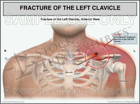 Clavicle Fracture Left Side Male Trial Exhibit Medical Malpractice