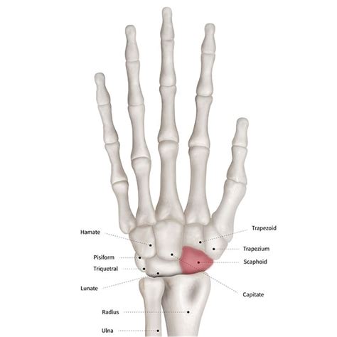 The team used the six generic headings to prompt ideas. Broken or Sprained Wrist - Brandon P. Donnelly, MD