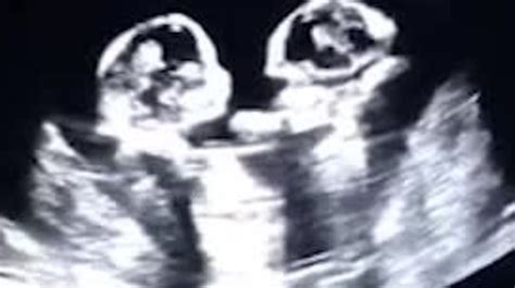 Ultrasound Scan Shows Identical Twins Fighting In Womb Video News
