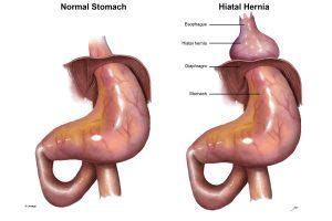 All You Must To Know About Hiatal Hernias Gi Surgical