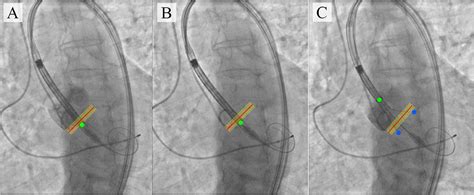 Frontiers Aortography Keypoint Tracking For Transcatheter Aortic