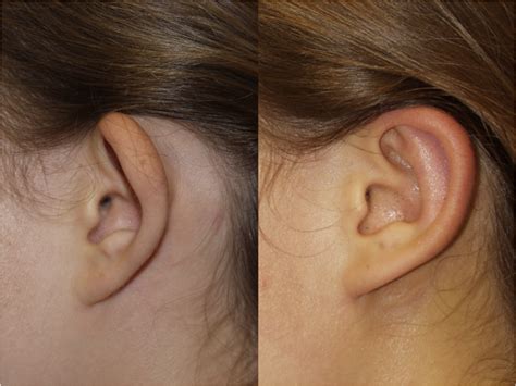 Before And After Pictures Otoplasty Ear Pinning Chicago Il Dr Sidle