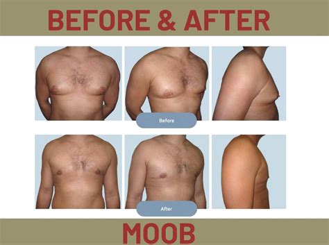 male breasts reduction gynecomastia treatment without surgery moob cream and capsule at rs