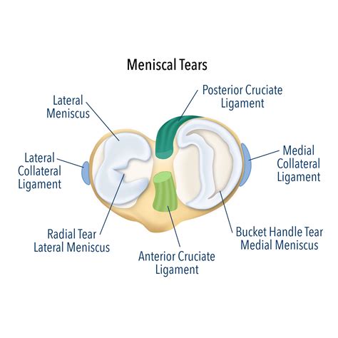 Meniscus Tear Treatment Meniscus Tear Surgery