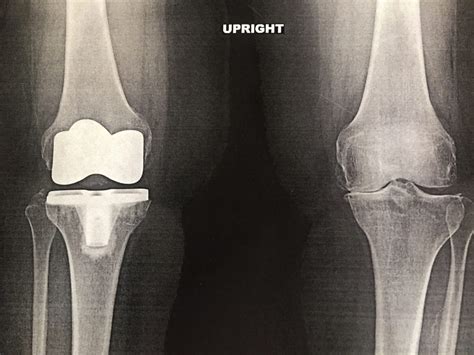 New Care Pathway Improves Chronic Pain After Total Knee Replacement
