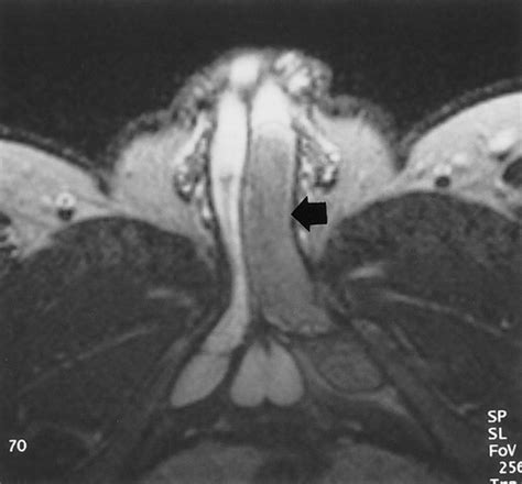 Mr Imaging Of The Penis Radiographics