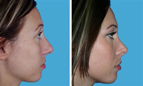 Learn More About Corrective Surgery For A Deviated Septum Boulder Co