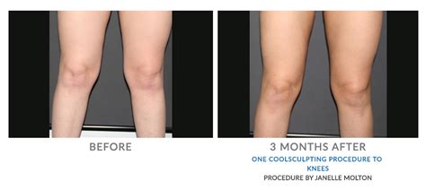 Coolsculpting By Zeltiq Adelaide Fat Freezing Epiclinic®