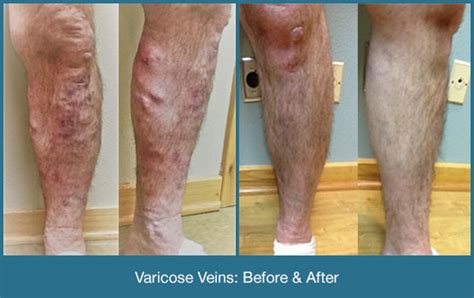 Before And Afters Arkansas Vein Clinic And Skin Care