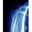 Broken Upper Arm Bone Photograph By Zephyr/science Photo Library
