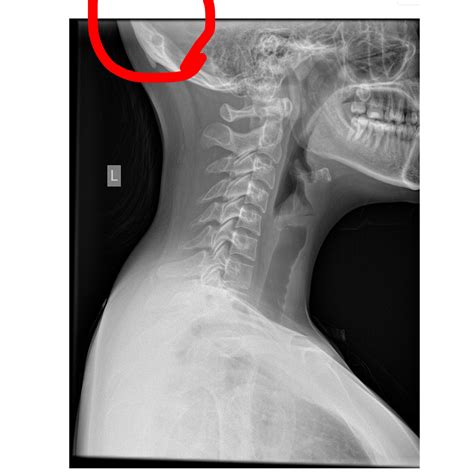 How Does My C Spine Look Also Any Idea What That Circled Part Is I
