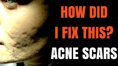 How To Treat Acne Scars Dermatologist Explains Youtube