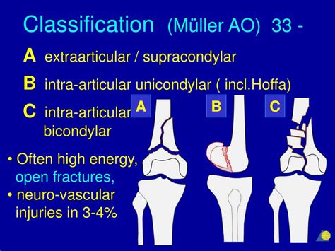 A fracture that occurs at the distal end of the femur bone, which includes the femoral condyles and the metaphysis. PPT - Distal Femur Fractures PowerPoint Presentation, free ...