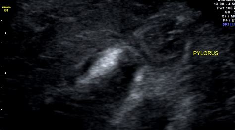 Whirlpool Sign Ultrasound Sumers Radiology Blog