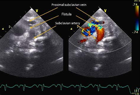 2 D Echocardiogram With Color Flow Doppler Showing Dilated Left