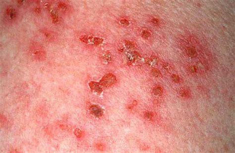 Images Of Shingles How To Cure Shingles Fast Shingles Cure