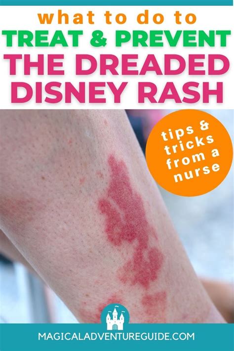 The Disney Rash A Nurse S Tips For Preventing And Treating It Magical Adventure Guide