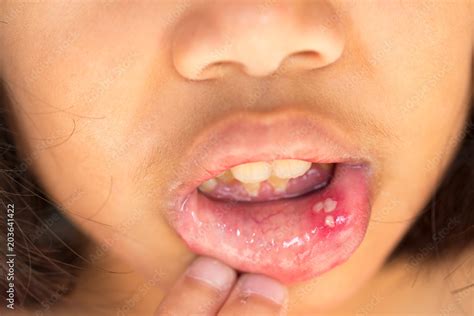 Foto De Mouth Ulcer Or Canker Sore Or Aphthous Stomatitis Or Aphthous