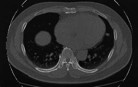 On Chest Ct Three Small Nodules Were Newly Detected In The Left Lower