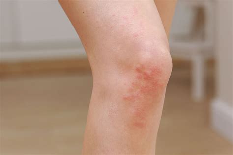 Dermatologists Provide Tips On How To Get Rid Of Heat Rash Fast