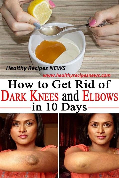How To Get Rid Of Dark Knees And Elbows In 10 Days Dark Elbows Beauty Remedies Skin Care