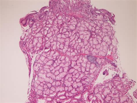 Pathologic Observations Of The Duodenum In Consecutive Duodenal Specimens I Benign Lesions