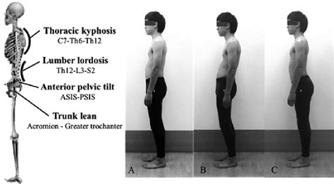Posture Defined Indicators A Neutral B Sway Back C Lordosis