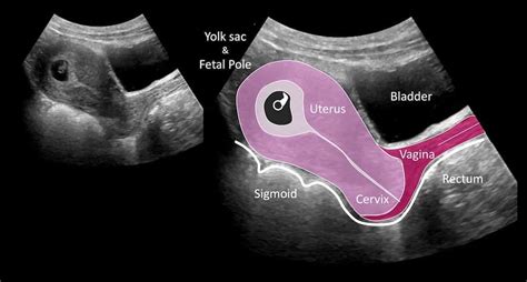 Pictures Of Pregnancy Ultrasound 15 Weeks Pregnant Ultrasound What
