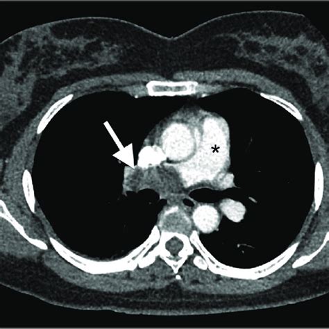 Axial Image Of The Chest From Cta Pulmonary Exam Showing The Large
