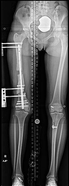 Shorter Leg After Femur Surgery Partners