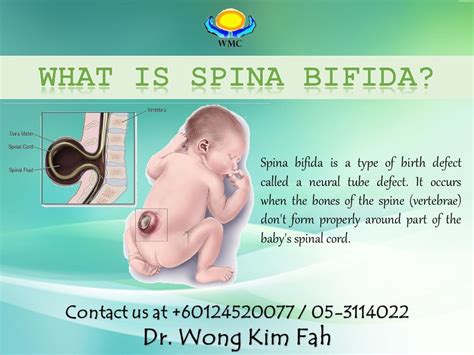 Understanding Spina Bifida Causes Symptoms And Treatments