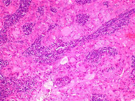 Mucoepidermoid carcinomas represent a distinct type of tumor. Mucoepidermoid carcinoma, low grade - Case 199 | Flickr ...