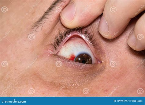 Eye Injury Young Man With Burst Blood Vessel In Eye Fatigue Problems
