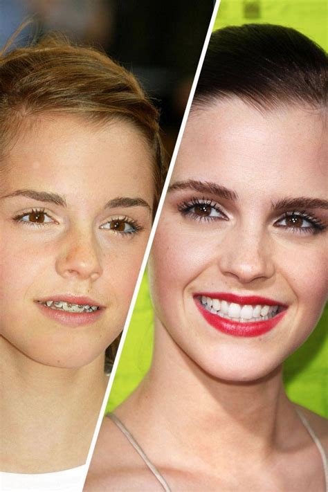 Check Out These Famous Faces With Braces Celebrities With Braces