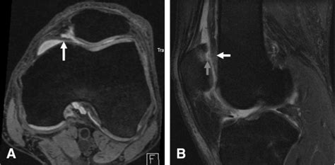Type C Mediopatellar Plica With Cartilage Damage And Bmls In The Medial